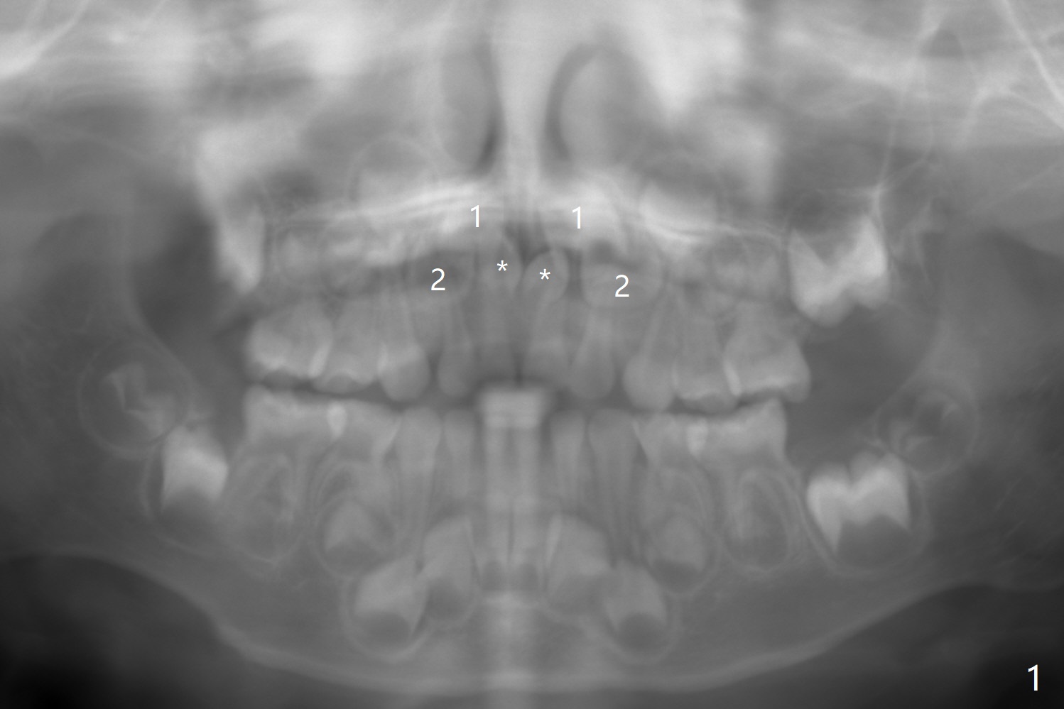 When To Extract Mesiodens Of A 3 Year old Boy Duluth Atlanta GA 